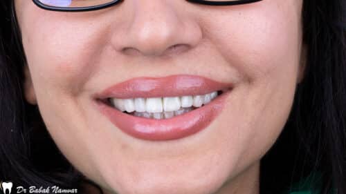 اصلاح طرح لبخند