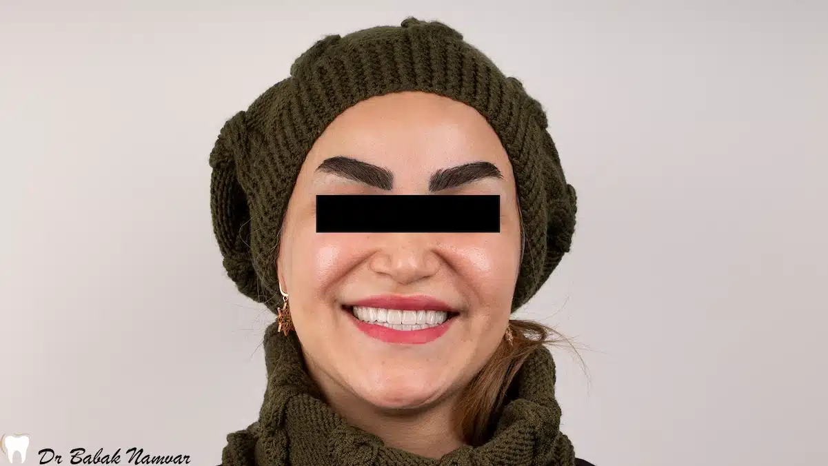 لمینت دندان