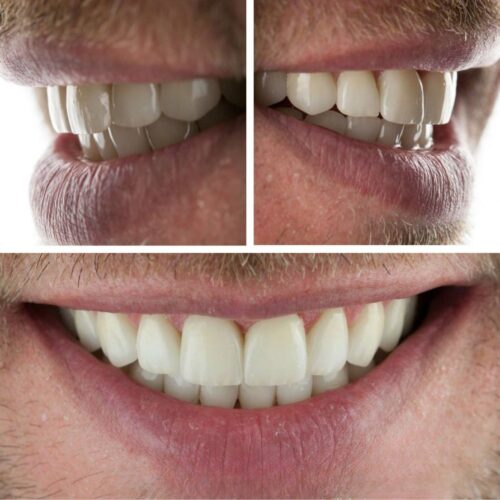 اصلاح طرح لبخند